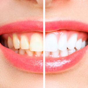 Teeth Whitening