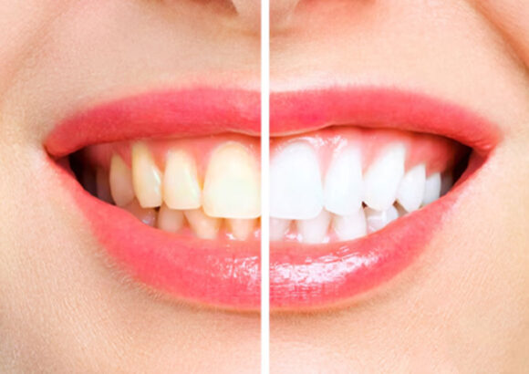 Teeth Whitening