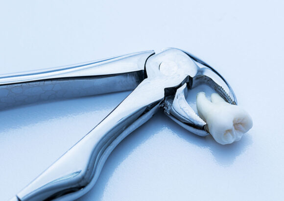 Extractions*