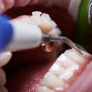 Dental Fillings