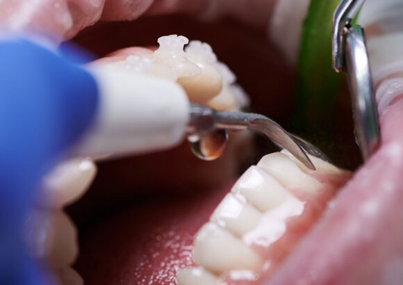 Dental Fillings