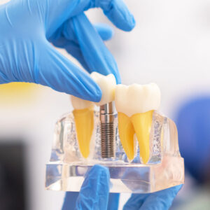 Dental Implants