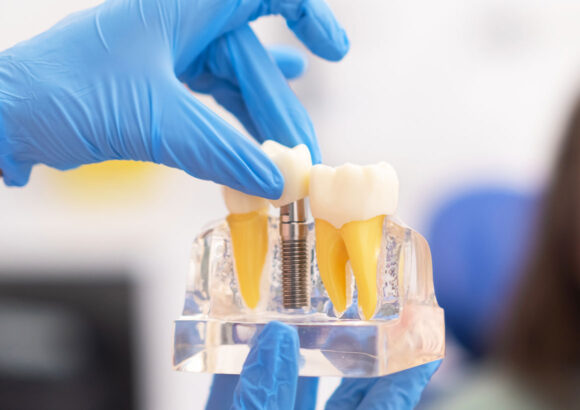 Dental Implants