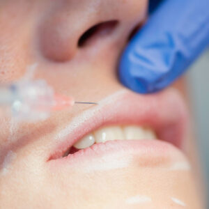 Fillers (face and lips)