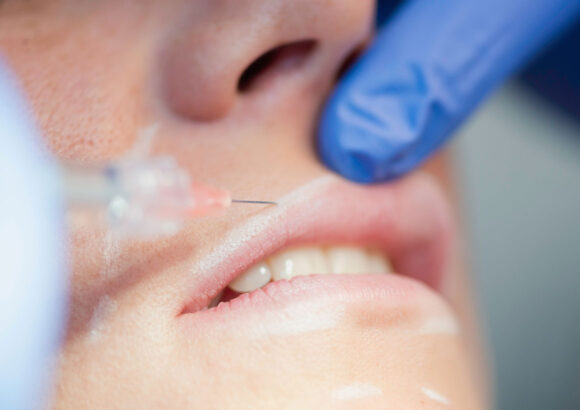 Fillers (face and lips)