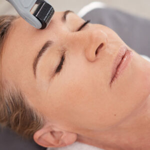 Microneedling