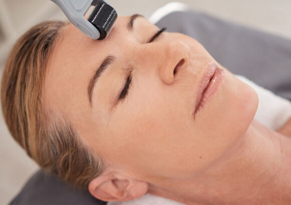 Microneedling